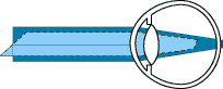 oeil astigmate